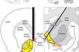 Position of ‘pleasure’ electrodes in a rat brain and a human brain.
