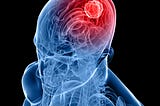 All About Glioblastoma