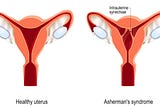 ASHERMAN’S SYNDROME