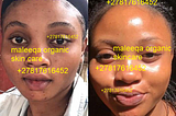 Safe Skin Whitening Injections in South Africa Johannesburg Vaal skin whitening injection without…