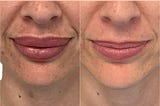 Case Study: Dissolving Lip Filler