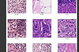 Identifying Metastatic Lymph Tissue with Tensorflow, Google Colab, and Google Cloud