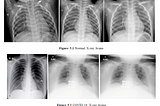 COVID-19 detection from Chest X_RAY using Convolutional Neural Network