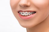 How Do Braces Work?