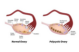 PCOD/PCOS