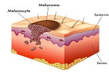 Is it Melanoma? Knowing These 5 Things Could Save a Life