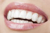 Invisalign: What You Need To Know