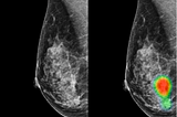 Improving the Detection of Breast Cancer Using AI