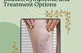 Varicose Veins Causes, Symptoms, and Treatment Options
