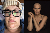 What To Expect From a Bone Marrow Transplant