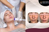 What are the Reasons Behind the Popularity of Laser Treatment for the Face?