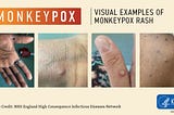Monkeypox — a global health issue after COVID-19
