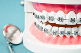 7 Benefits of Choosing Metal Braces for Orthodontic Treatment