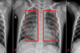 X-ray of a patient with covid pneumonia (Image 1 and 2) and a healthy patient without the presence of pneumonia (Image 3)