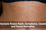 Pityriasis Rosea Rash: Symptoms, Causes, and Home Remedies