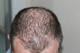 stop hair loss in men