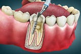 Root Canal Therapy Side Effects: What No One Tells You