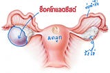 บ่งบอกอาการซีสต์แยกประเภทต่างๆ