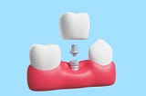 Understanding Dental Crowns and Their Role in Dental Health