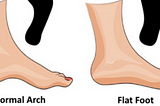 Let’s understand about Flat feet deformity