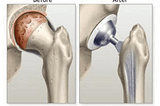 Knee Replacement Surgery, Step-by-Step Description