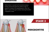 Know About Various Stages of Gum Diseases By Edmonton Dentist