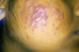 Acne Vulgaris/ Pimples