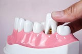 What Are The Reasons to Choose Implants Over Dentures?