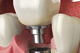 The break through of dental iplants — George Pegios