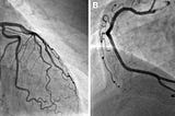 Left Main Heart Stent at Age 34: The Importance of Lipoprotein(a)
