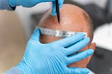 Hair Transplant Surgery: What You Need to Know