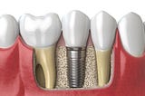 6 Facts You Need To Know About Dental Implants