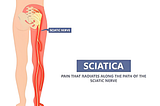 Last Stages of Sciatica: Signs of Your Sciatica Pain Healing