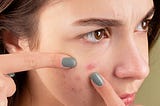 How to Treat Hormonal Acne