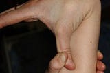 Ehlers-Danlos Syndrome