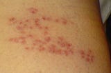 Is Shingles Contagious?