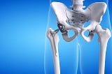 Hip Replacement Surgery in Lincolnshire