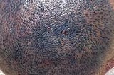 Does crown hair transplant take longer to grow?Why