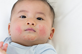 Does My Baby Have Eczema