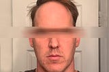 Everything I’ve Learned About Benign Paroxysmal Positional Vertigo (BPPV) in the Week I’ve Had It