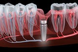 Can Dental Implants Cause Neurological Problems?