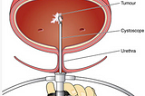 Transurethral Resection of a Bladder Tumour — Transurethral Resection of a Bladder Tumour-Bladder…