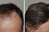 How Much Do Hair Implants Cost in Turkey?
