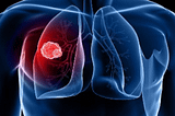 Effective Are These New Treatments of Lung Cancer