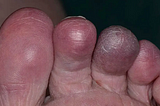 Cyanosis on Feet: Blue Toes, Seek the Clues