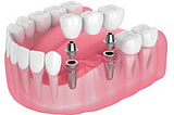 dental implants in Tomball