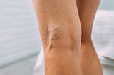 Enlarged veins on the back of the knee.