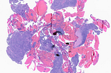 Follicular Lymphoma Involving Cervix