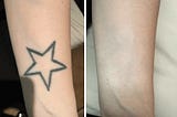 Why PicoSure is the Best Tattoo Removal Solution