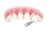 Problems With Veneers
